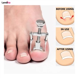 دستگاه ارتودنسی ناخن پا Nails